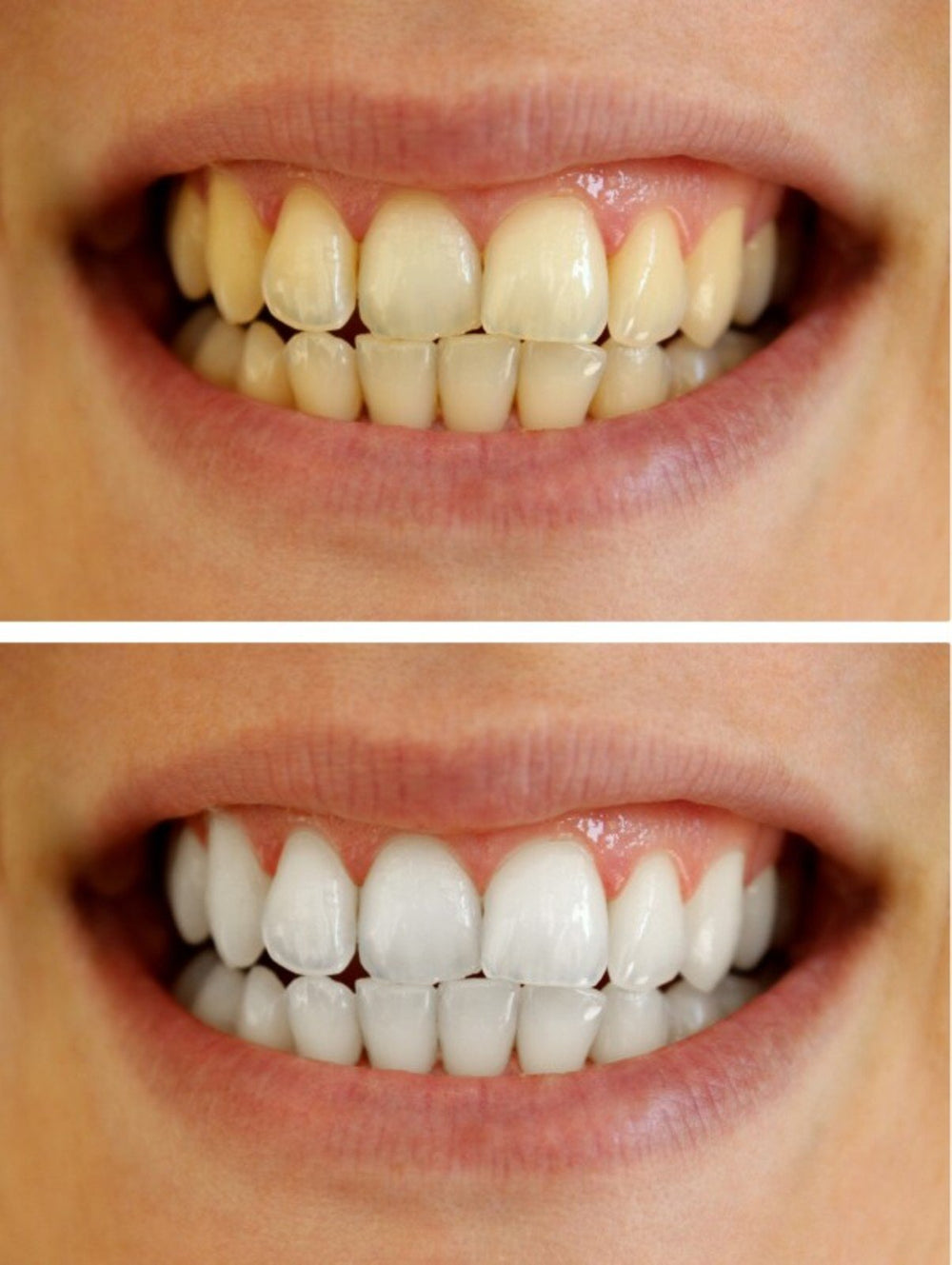 Bleach Pro Whitening gel syringe with cap removed, prepared for topical application.