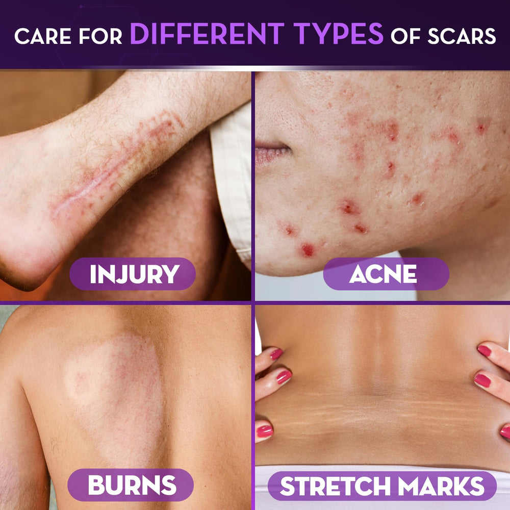 Stretch-marked skin with Cicatricure gel for color and texture enhancement
