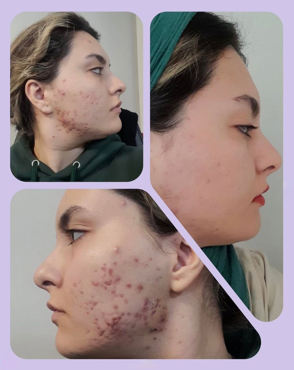 Demodexcillin Skin Solution spray in action on skin shows quick absorption