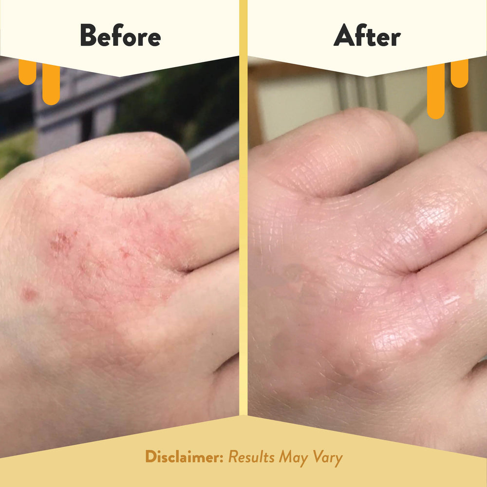 Close look at honey, aloe, oatmeal, and grapeseed oil ingredients in ECZEMA HONEY