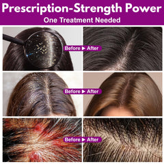 Close-up of scalp shows lice eggs loosened by Euphea lotion.