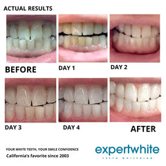 Custom or universal trays with Expertwhite for even tooth whitening