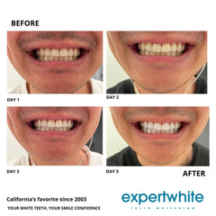 At-home whitening setup using Expertwhite gel and trays for consistent results