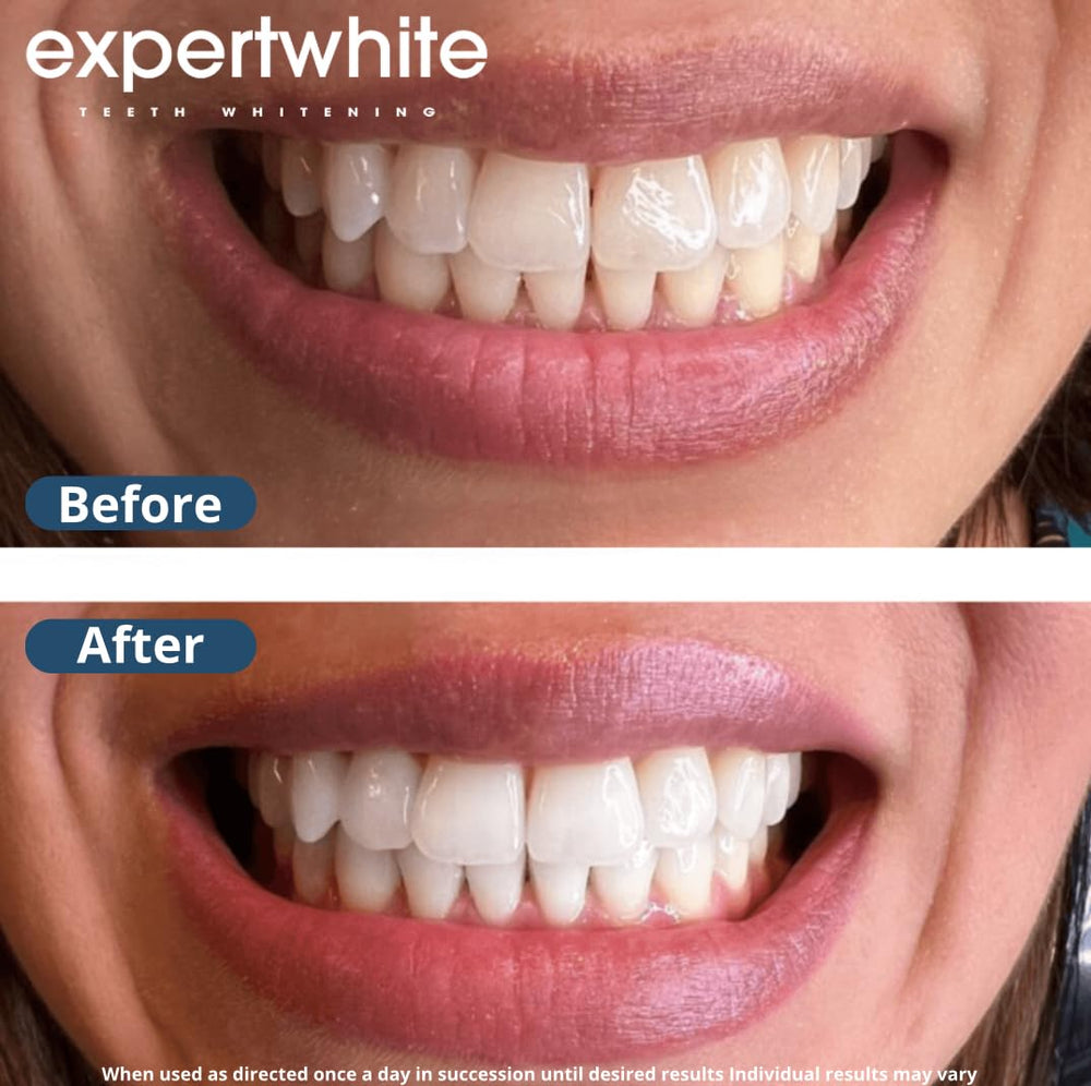 Expertwhite fast whitening sessions in about 15 minutes.