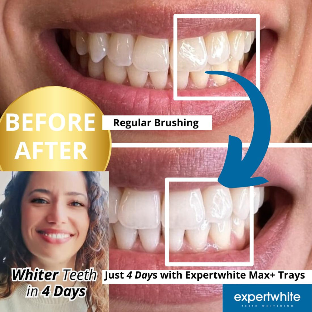 ExpertWhite Max Glow Trays 10-tray kit enables complete upper and lower sets.