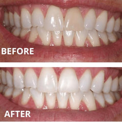 Expertwhite gel compatible with custom trays like Invisalign.
