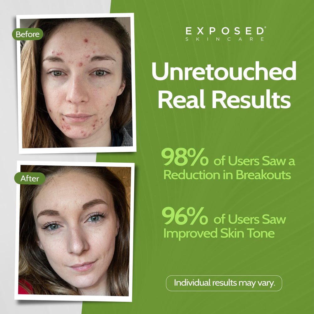 Exposed Skin Care packaging box highlighting vegan, non-GMO probiotic formula.
