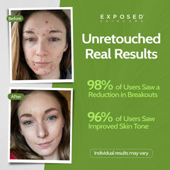 Exposed Skin Care packaging box highlighting vegan, non-GMO probiotic formula.