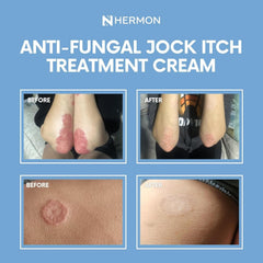 Hermon Jock Itch Cream after-use look suggests comfortable skin.