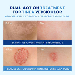 Hermon Tinea Versicolor Kit Box shows two-step treatment for fungal skin concerns.