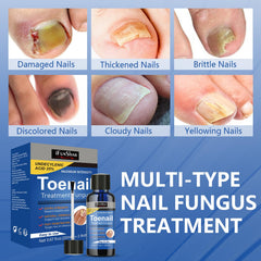 IFUNSHAR bottle shows 25% undecylenic acid formula for nails.
