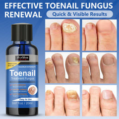 IFUNSHAR-treated nail showing smoother appearance.