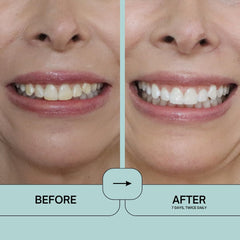 IntelliWHiTE ProStrips box and tube ready for an at-home whitening routine.