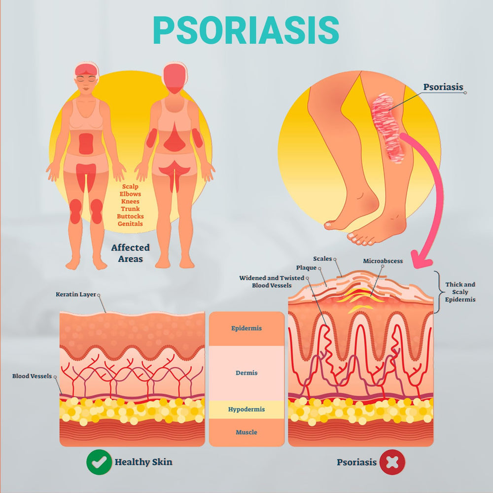 Hand applying Ishancare Psoriasis Cream for targeted care