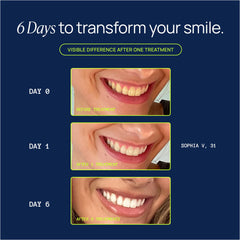 Laughland Original Teeth Whitening Kit 8-percent hydrogen peroxide for effective whitening.