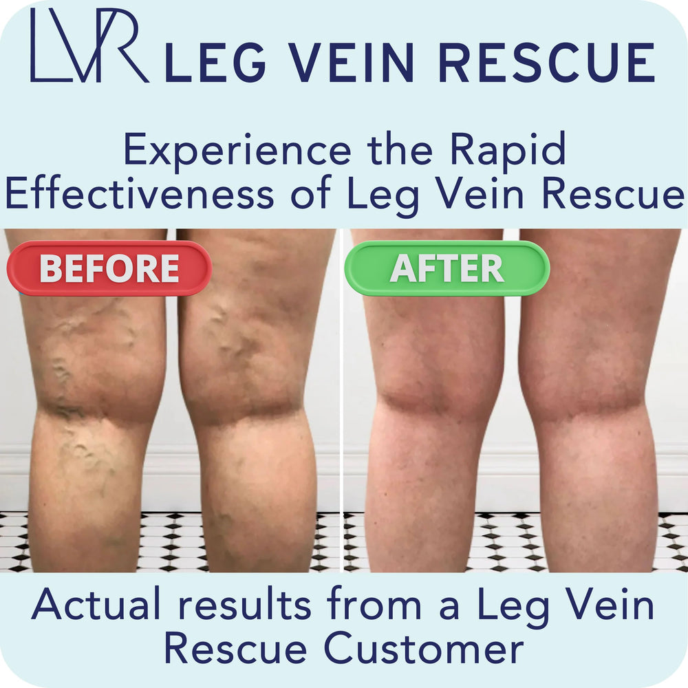 LEG VEIN RESCUE diosmin complex with high bioavailability