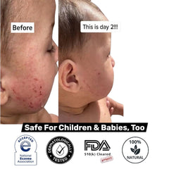 Loma Lux Eczemol suitable for kids and adults, gentle spray