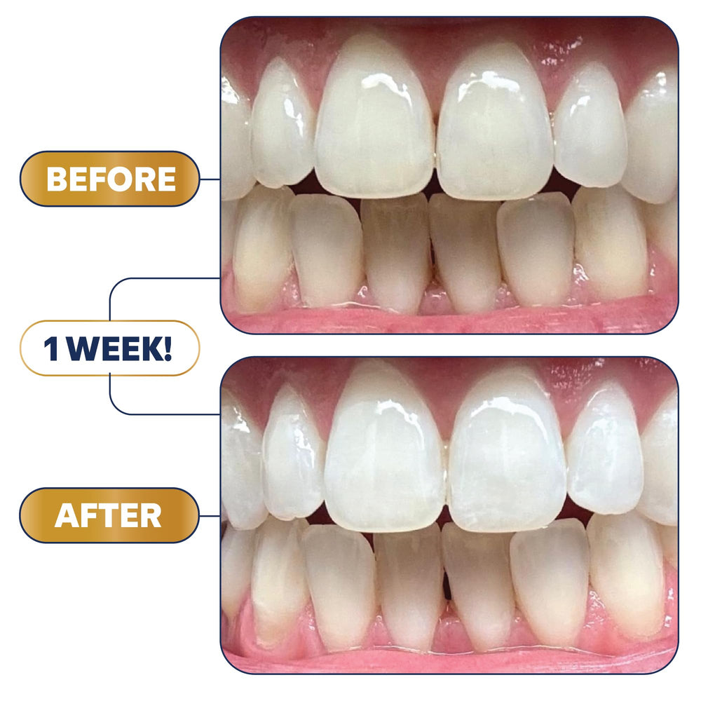 Lumineux Longevity long-lasting whitening with minimal sensitivity