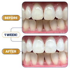 Lumineux Longevity long-lasting whitening with minimal sensitivity
