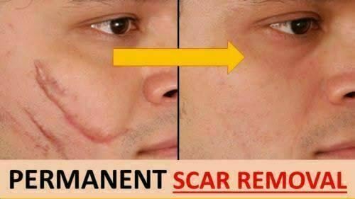 MEBO Burn Cream in a portable first aid kit