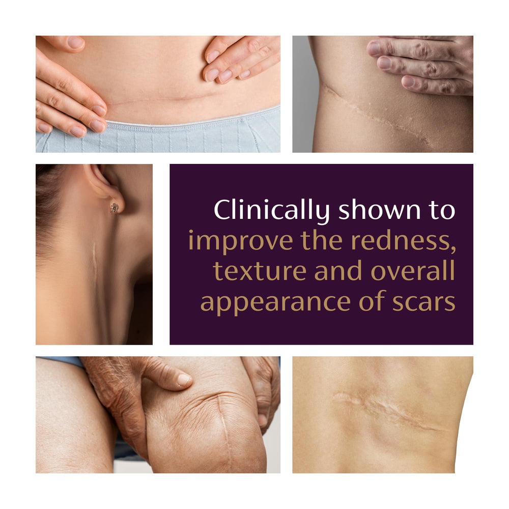 Mederma Advanced Scar Gel on skin illustrates visible scar improvement potential.