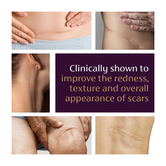 Mederma Advanced Scar Gel on skin illustrates visible scar improvement potential.