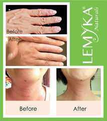 Michaderm LEMYKA image shows daily-use application on face and hands.