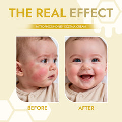 Mitrophics Honey Eczema Cream applied to the face to calm delicate areas.