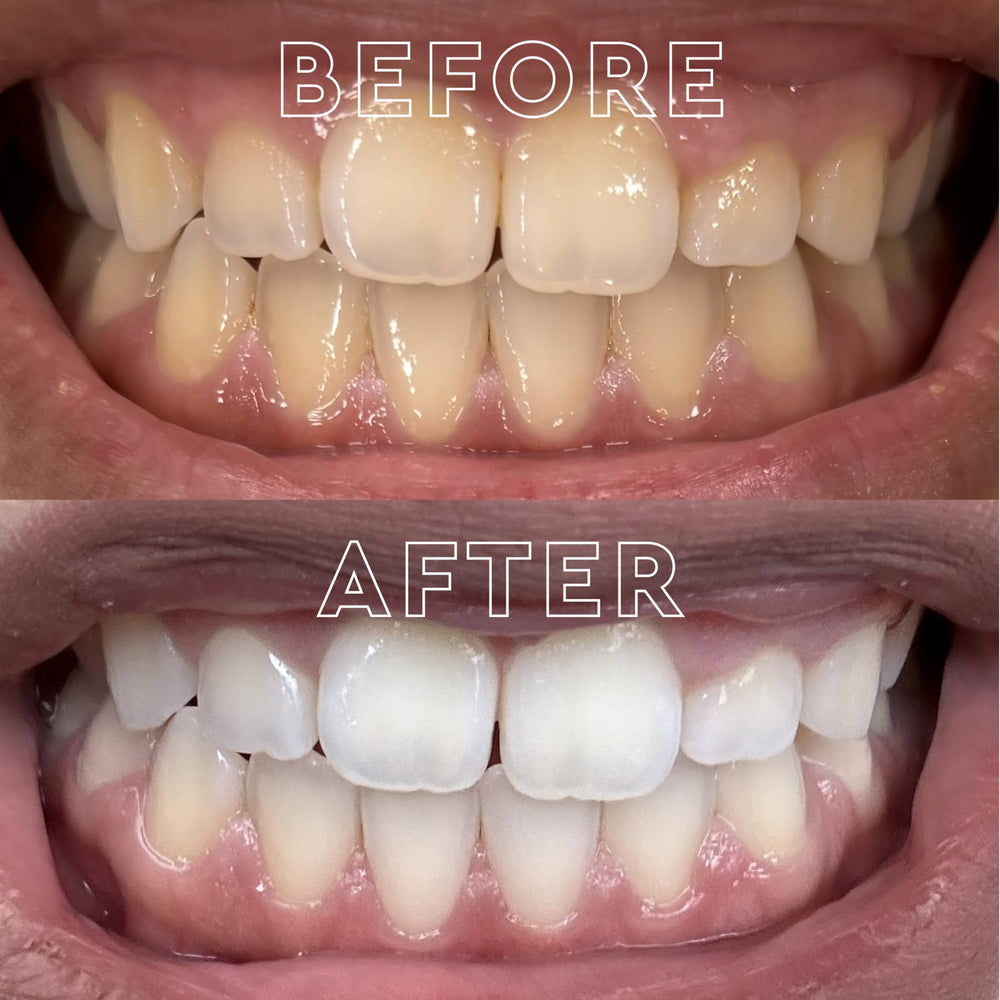 MOON Midnight Mint strip dissolving on tooth shows fast 15-minute action.