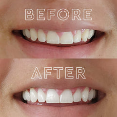 MOON peppermint whitening strips ready for two-week treatment at home.