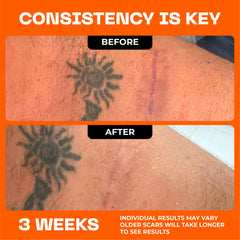 Motivo Scar Care used on facial scars for daily wear.