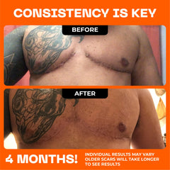 Motivo Scar Care designed for discreet wear under clothing.