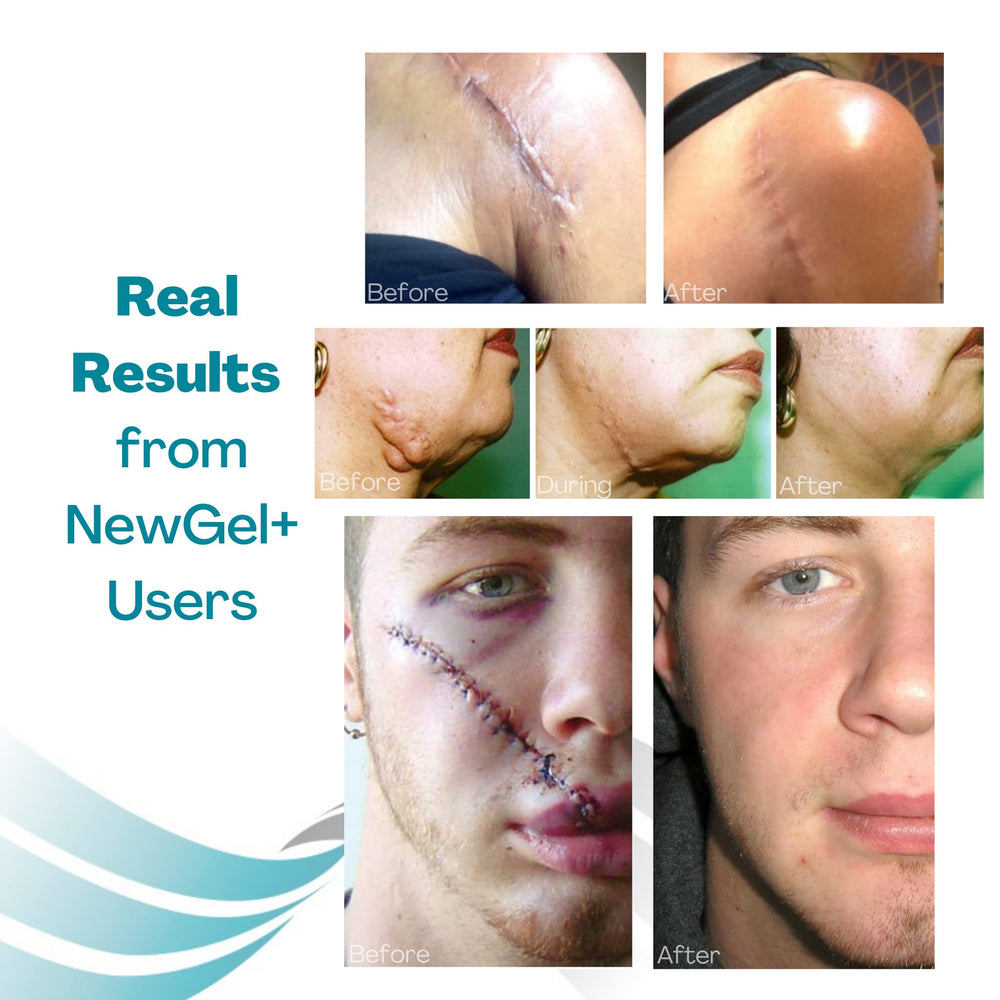 MyNewGel beige anchor sheet suitable for FTM top surgery scars.