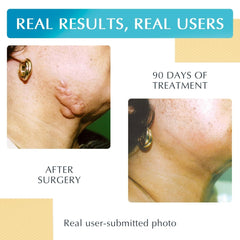 MyNewGel scar sheet applied on skin in beige for discreet coverage