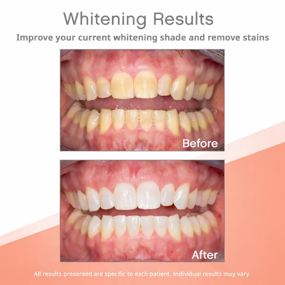 Opalescence Go 10 percent hydrogen peroxide gel provides whitening without LEDs.