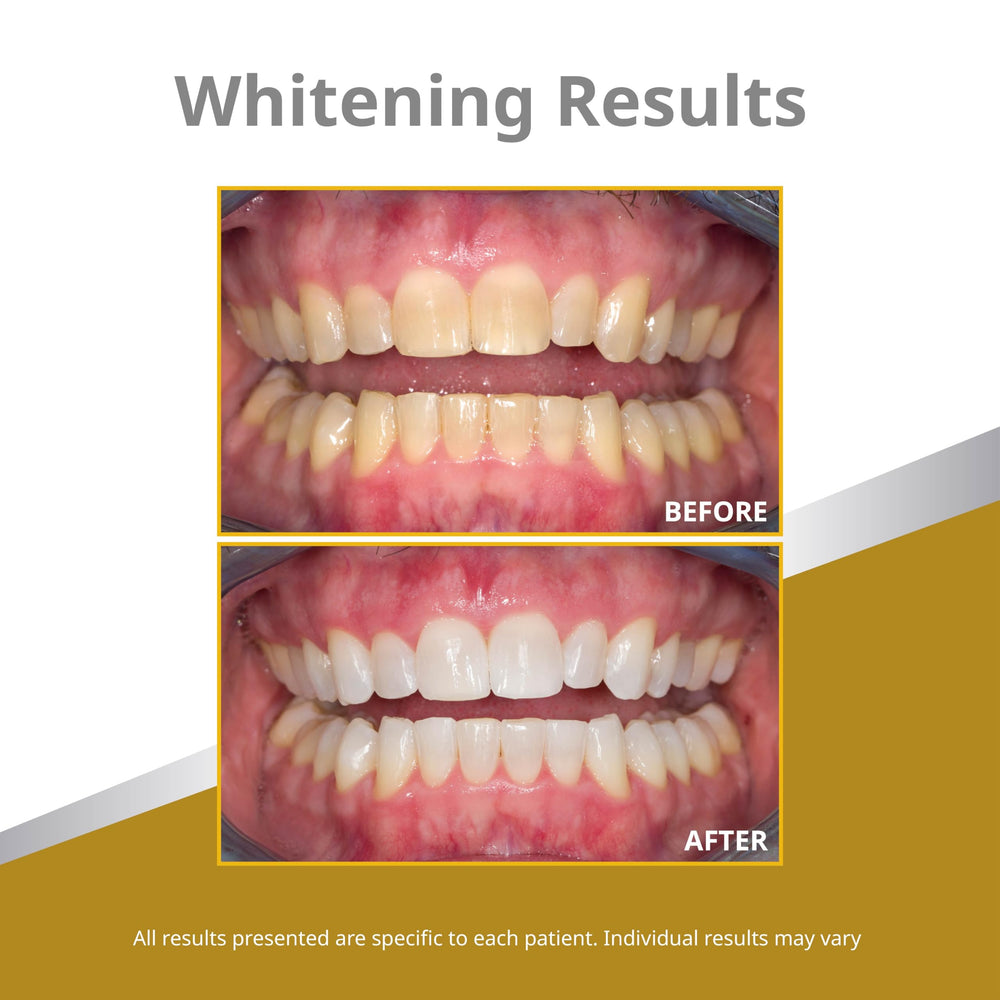 Opalescence xylitol-sweetened gel supports whitening
