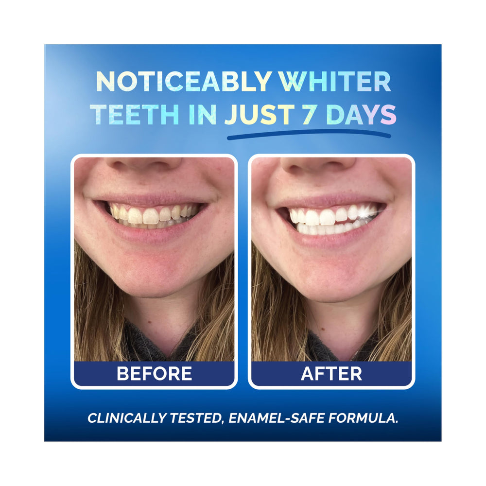 POP ON VENEERS close-up showing whitening on enamel
