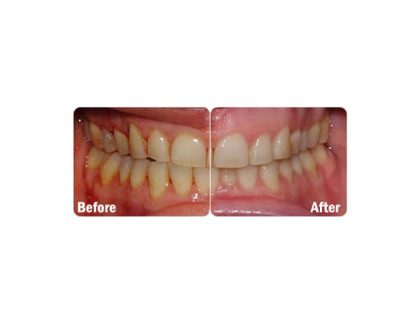 Bright smile after daily ProBiora Health use.
