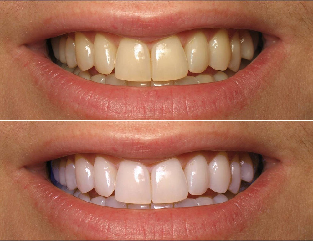 ProDental 35% carbamide peroxide gel ready for effective stain removal