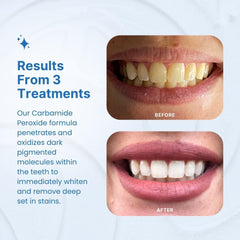 PurelyWHITE DELUXE moldable mouth trays for a comfortable fit