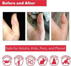 Applying Puremedy Ointment on skin to soothe minor irritation.