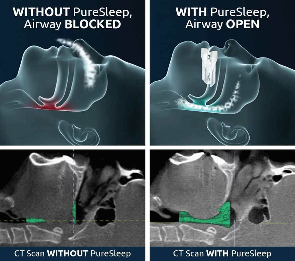 PureSleep two-component mechanism - low-profile, secure fit