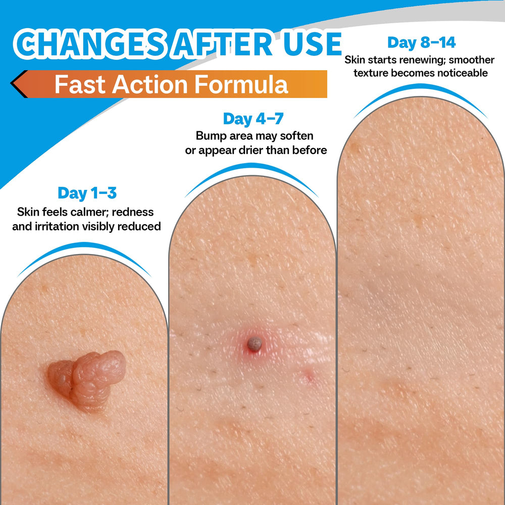 SHUNNIUB molluscum cream packaging highlighting natural ingredients