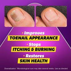 Applying Silka around the toenail to treat surrounding affected skin.