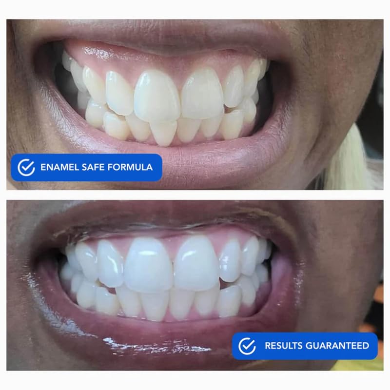 Snow DiamondSeries whitening strips on application tray for precise placement