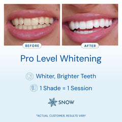 SNOW wireless teeth whitening kit shown for cord-free sessions.