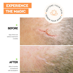 Strataderm itch relief scar gel helps calm irritated skin