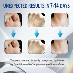 Teklar Wart Remover Cream common wart action for quick treatment.