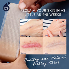 TEREZ & HONOR scar tape is colorless and odorless, suitable for sensitive skin.