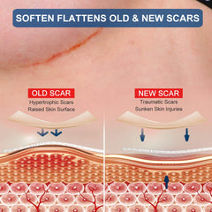 ZODENIS breast scar sheets showing anchor strips for broader scar coverage.